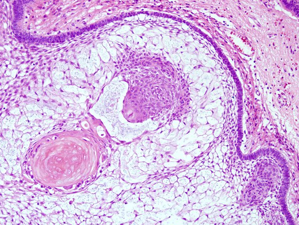 4B3 Craniopharyngioma (Case 4) H&E 3.jpg