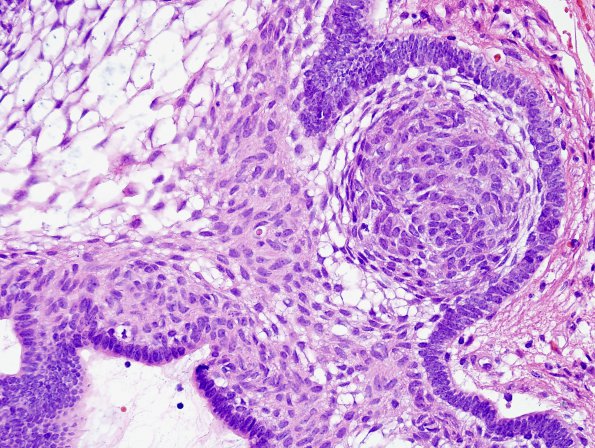 4B4 Craniopharyngioma (Case 4) H&E 4.jpg