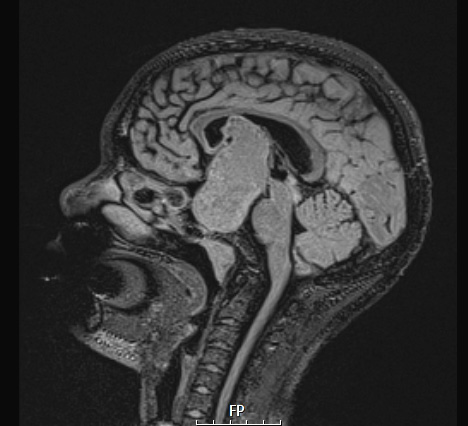 5A1 Craniopharyngioma, adamantinomatous (Case 5) FLAIR - Copy - Copy