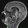 5A2 Craniopharyngioma, adamantinomatous (Case 5) T1 1 - Copy - Copy