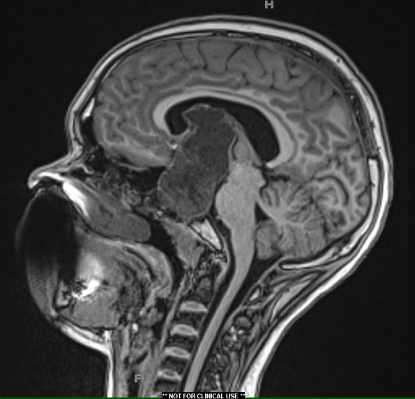 5A2 Craniopharyngioma, adamantinomatous (Case 5) T1 1 - Copy - Copy