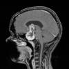 5A3 Craniopharyngioma, adamantinomatous (Case 5) T1 W3 - Copy - Copy