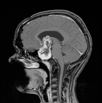 5A3 Craniopharyngioma, adamantinomatous (Case 5) T1 W3 - Copy - Copy