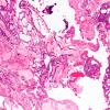 5B1 Craniopharyngioma, adamantinomatous (Case 5) H&E 10X 3