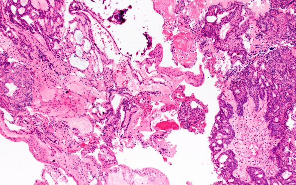 5B1 Craniopharyngioma, adamantinomatous (Case 5) H&E 10X 3