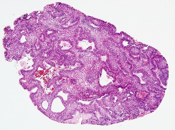 5B4 Craniopharyngioma, adamantinomatous (Case 5) H&E 1.jpg