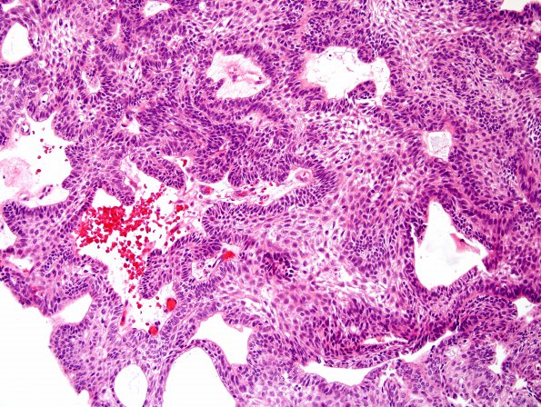 5B5 Craniopharyngioma, adamantinomatous (Case 5) H&E 3.jpg