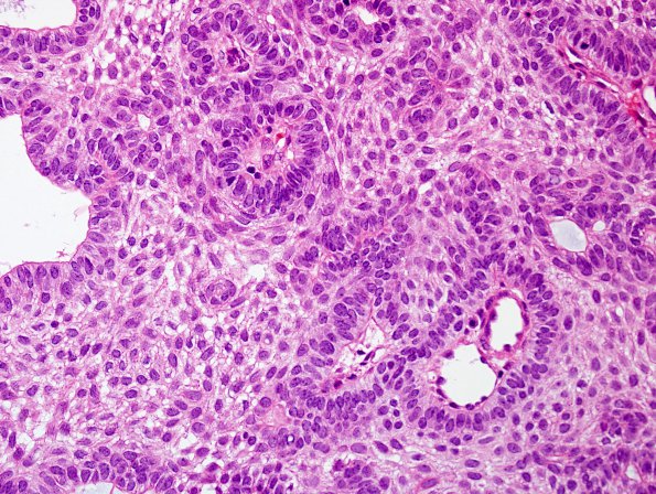 5B6 Craniopharyngioma, adamantinomatous (Case5) H&E 9