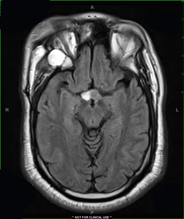 6A1 Craniopharyngioma (Case 6) FLAIR 1 - Copy