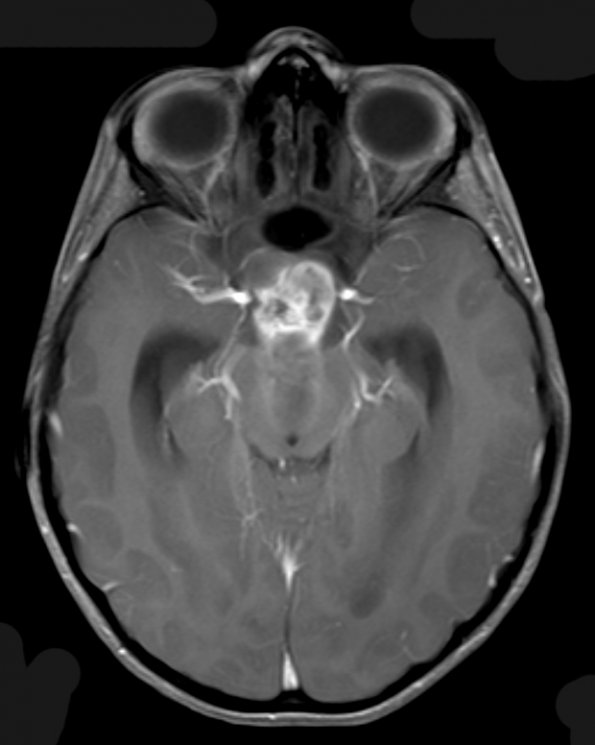 6A2 Craniopharyngioma (Case 6) T1 W 5 - Copy