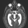 6A3 Craniopharyngioma (Case 6) T2 - Copy