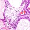 6B2 Craniopharyngioma (Case 6) H&E 3A