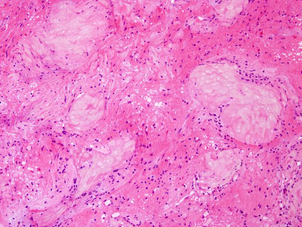 6B4 Craniopharyngioma (Case 6) H&E 7.jpg