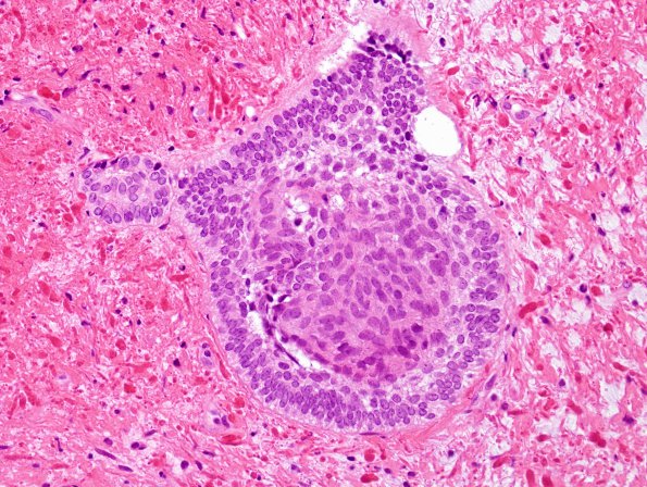 6B7 Craniopharyngioma (Case 6) H&E 6.jpg