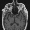 7A1 Craniopharyngioma (Case 7) T1 1 - Copy