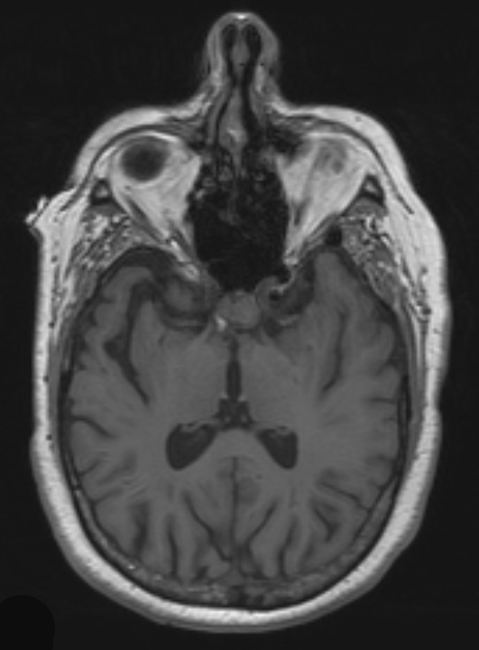 7A1 Craniopharyngioma (Case 7) T1 1 - Copy