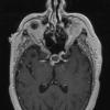 7A2 Craniopharyngioma (Case 7) T1 W 1 - Copy