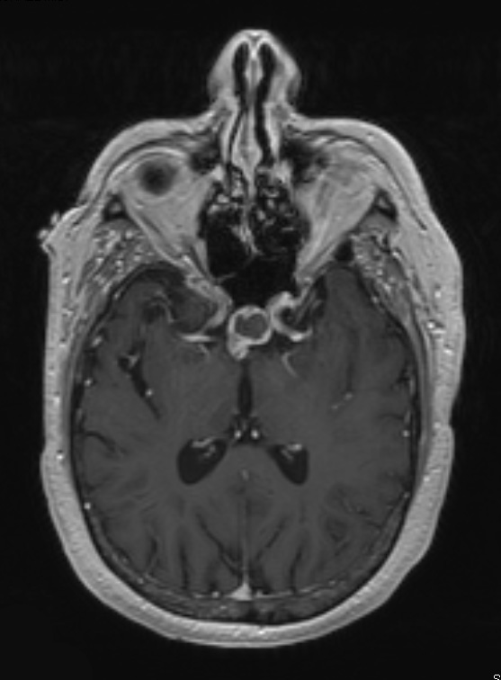 7A2 Craniopharyngioma (Case 7) T1 W 1 - Copy