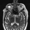 7A3 Craniopharyngioma (Case 7) T2 W 1 - Copy