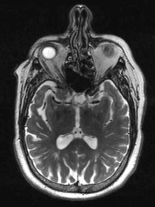 7A3 Craniopharyngioma (Case 7) T2 W 1 - Copy