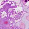 7B2 Craniopharyngioma (Case 7) H&E 4