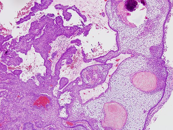 7B2 Craniopharyngioma (Case 7) H&E 4