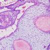 7B3 Craniopharyngioma (Case 7) H&E 2