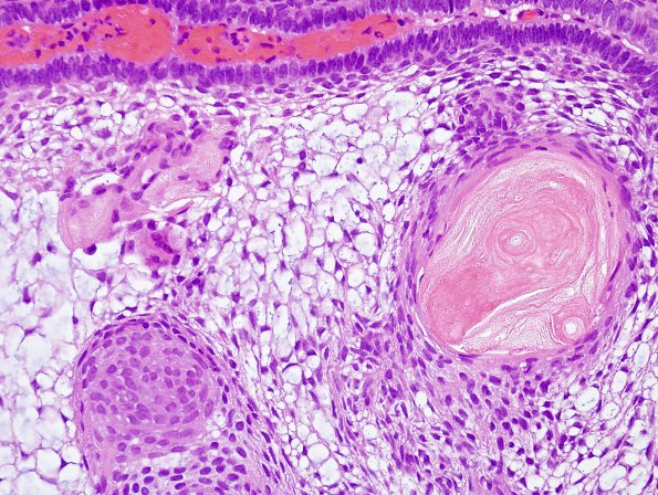 7B4 Craniopharyngioma (Case 7) H&E 1