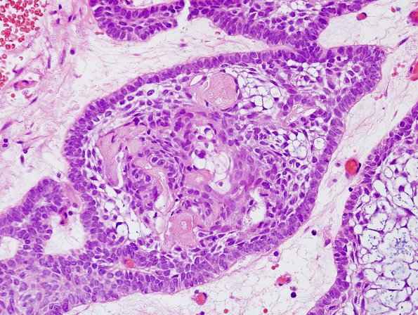 7B5 Craniopharyngioma (Case 7) H&E 3