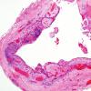 8B1 Cranio, hemorrhage, reaction (Case 8) H&E 1.jpg