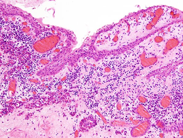 8B3 Cranio, hemorrhage, reaction (Case 8) H&E 9.jpg