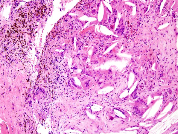 8B4 Cranio, hemorrhage, reaction (Case 8) H&E 6.jpg