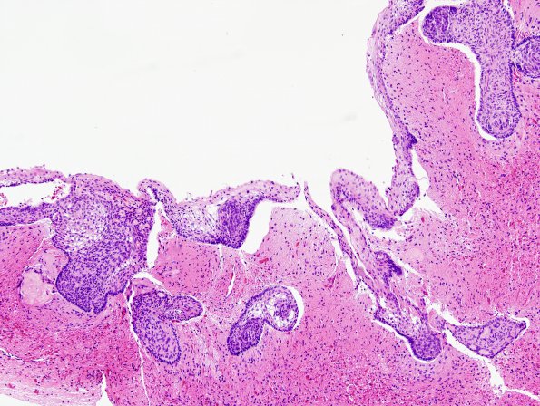 9B1 Craniopharyngioma, within 3rd ventricle (Case 9) 7