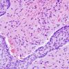 9B5 Craniopharyngioma, within 3rd ventricle (Case 9) 5