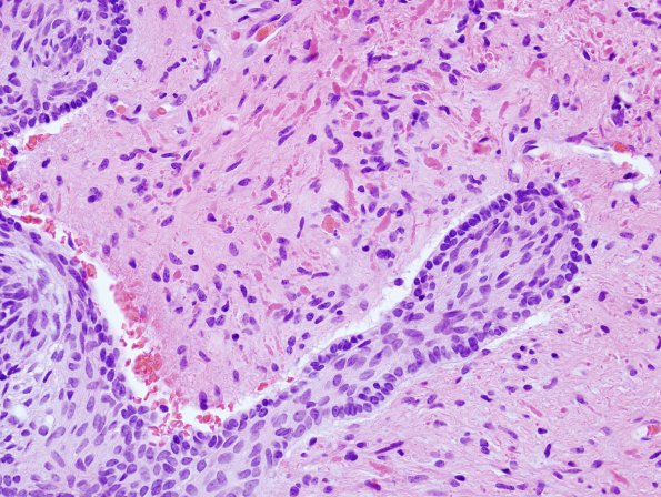 9B5 Craniopharyngioma, within 3rd ventricle (Case 9) 5