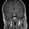 1A1 Craniopharyngioma, papillary (Case 1) T1 1 - Copy copy