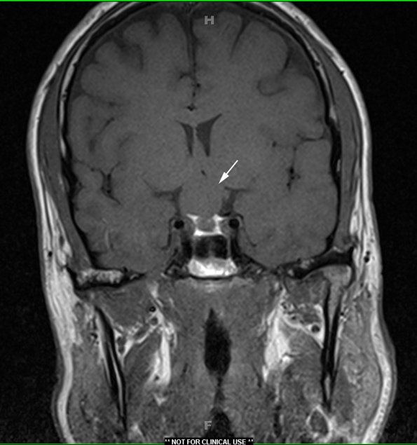 1A1 Craniopharyngioma, papillary (Case 1) T1 1 - Copy copy