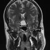 1A2 Craniopharyngioma, papillary (Case 1) T2 Pituitary W 2 - Copy