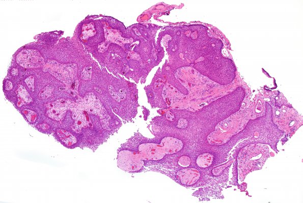 Craniopharyngioma, papillary (Case 1) H&E 4X 7.jpg