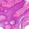 1B2 Craniopharyngioma, papillary (Case 1) H&E 10X 3