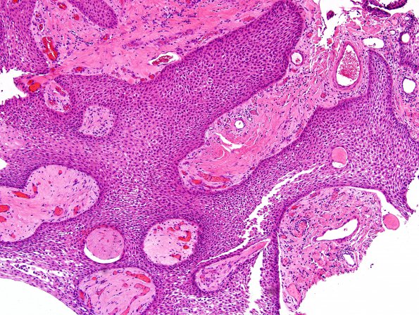 1B2 Craniopharyngioma, papillary (Case 1) H&E 10X 3