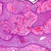 1B3 Craniopharyngioma, papillary (Case 1) H&E 10X 1