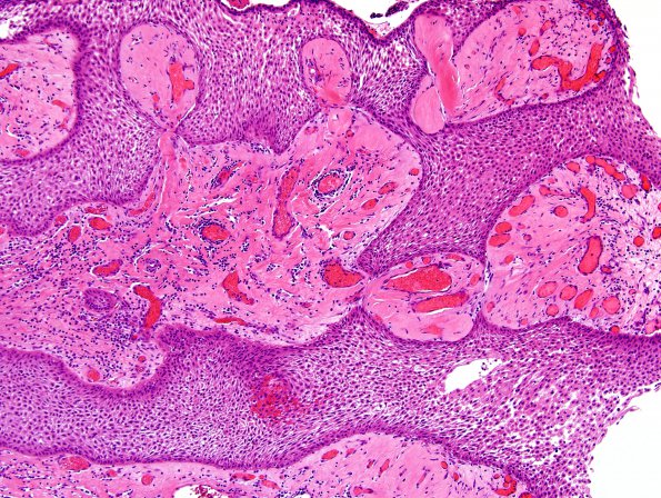 1B3 Craniopharyngioma, papillary (Case 1) H&E 10X 1