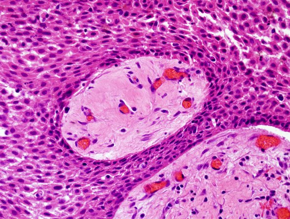 1B5 Craniopharyngioma, papillary (Case 1) H&E 3.jpg