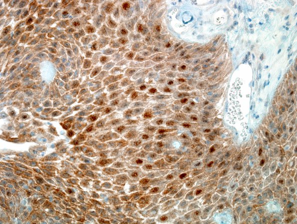 1C2 Craniopharyngioma, papillary (Case 1) BRAF V600E 1