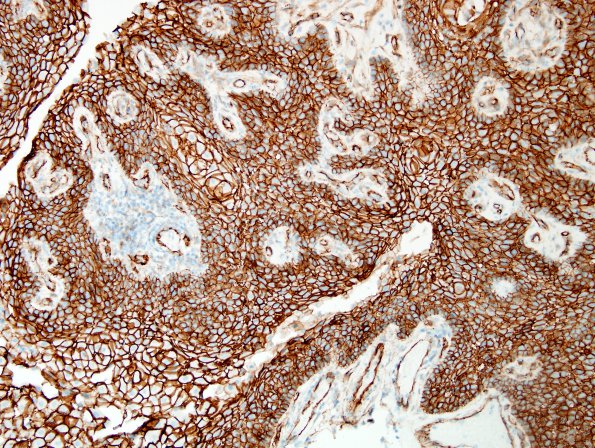 1D1 Craniopharyngioma, papillary (Case 1) B-Catenin 4.jpg