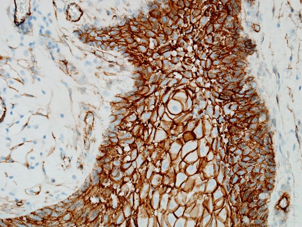 1D3 Craniopharyngioma, papillary (Case 1) B-Catenin 1.jpg