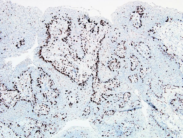 1E Craniopharyngioma, papillary (Case 1) Ki67 1