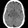 2A1 Craniopharyngioma, Papillary (Case 2) CT - Copy