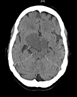 2A1 Craniopharyngioma, Papillary (Case 2) CT - Copy